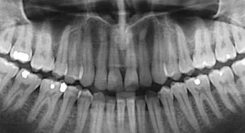 Apicoectomies: The Basics