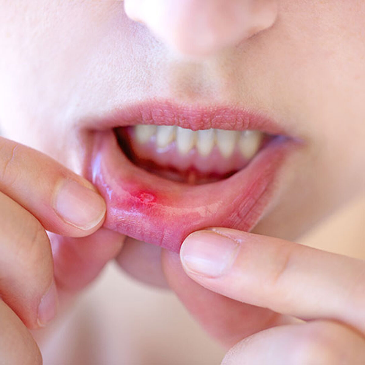 can vapes cause canker sores Canker Sores: Prevention, Causes, and Treatment